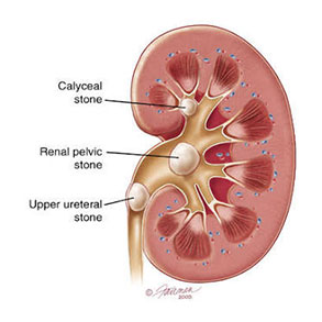 Prostatitis